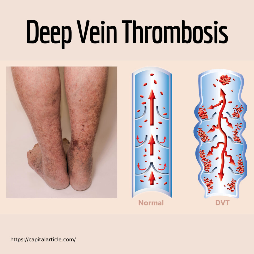 Blood Clot, deep vein, DVT, swelling, Venous Stasis