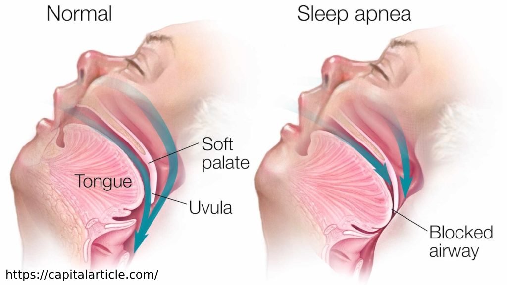 Central Sleep Apnea, Loud Snoring, Obstructive Sleep Apnea, Pauses in Breathing, sleep disorder